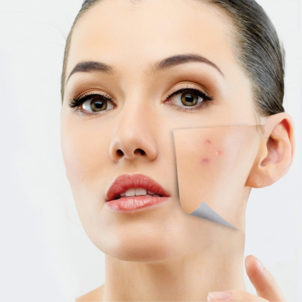 acne-is-treatable-online