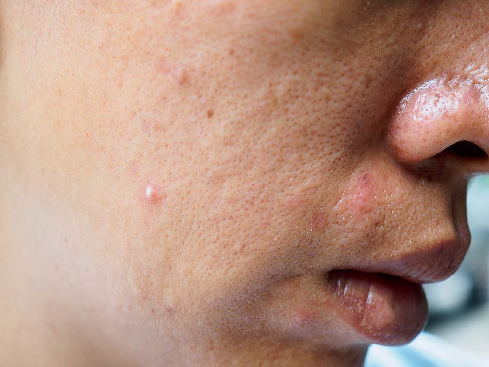 Allergic reaction bumps on face treatment